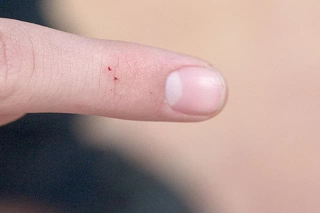 Black widow spider bite on skin